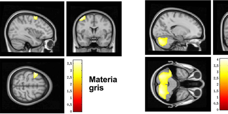 Gráfico materia gris cerebro