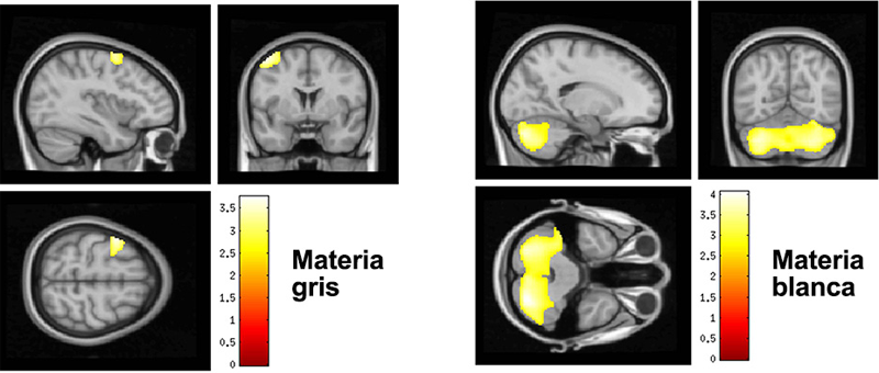 Gráfico cerebro materia gris